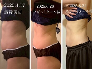 エステティックサロン アールグレー 名古屋駅店/《ソギレ&スリム》お腹/2クール