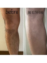 モアナ 前橋店(Moana)/MENS足脱毛