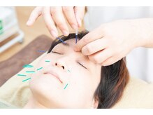 スクナビコナ鍼灸院/美容鍼の様子