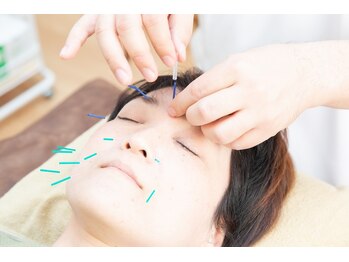 スクナビコナ鍼灸院/美容鍼の様子