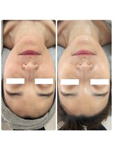 エステサロンブランシュ(Esthe salon Blanche)/ハーブピーリングでエイジング