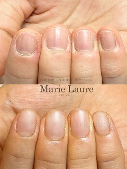 マリーロール 淀屋橋本店(Marie Laure)/自爪育成/深爪矯正/ネイルケア