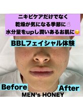 ハニーアイズ(Honey Eyes)/当日予約限定BBLフェイシャル