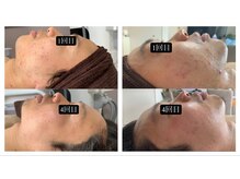 サマラボ 三軒茶屋(Sama Labo)/Before→After(ニキビケア)