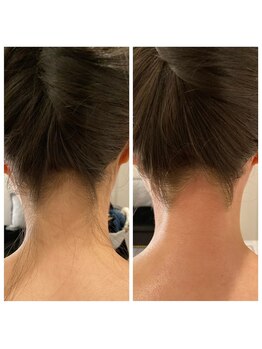 パームスエル(palms.L)/《うなじ脱毛》