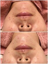 ロゼブランシュ(Rose Blanche)/大人のニキビケア、産後の肌荒れ