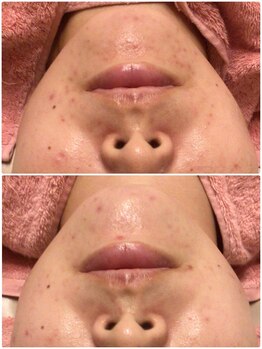 ロゼブランシュ(Rose Blanche)/大人のニキビケア、産後の肌荒れ