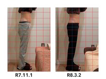 よしの鍼灸整骨院/産後骨盤矯正　　31歳　20回