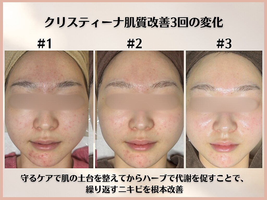 肌質改善エステサロン♡ シンスプラス(SINCE+)｜ホットペッパービューティー