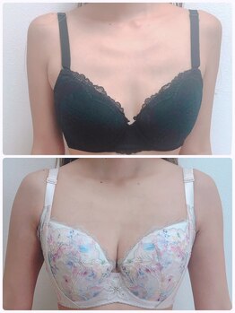 アンドモア(&more)/バストアップ症例