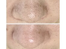 ルナート(Lunart)/毛穴洗浄／毛穴ケア