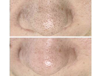 ルナート(Lunart)/毛穴洗浄/毛穴ケア