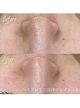 エスト(este.)/ハイドロ毛穴洗浄フェイシャル