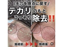 ソワラ(Soiela)の雰囲気（《毛穴エクストラクション》黒ずみ・いちご鼻・ニキビケアに◎）