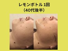 アユアランリンク 錦糸町店/レモンボトル1回