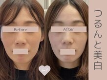 ベアール(beal)/透明感美白フェイシャルケア3回