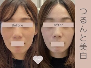 ベアール(beal)/透明感美白フェイシャルケア3回