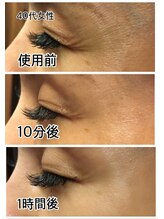 ウニ(uni)/【REVIハーブピーリング】