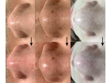 パイシーズ(Pisces)の雰囲気(毛穴洗浄で毛穴の黒ずみ詰まりが一度の施術でここまで綺麗に!)