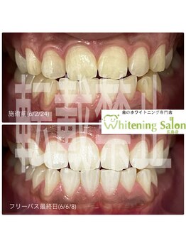 ホワイトニングサロン 広島店/【ホワイトニング施術例】