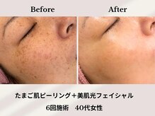 ティアラ 葛西店(TIARA)/40代女性 6回施術