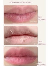 韓国肌管理yeoun【ヨウン】ROMAPINK/黒ずみ/毛穴/プラピール/ララピール福岡天神/ローマピンク福岡/メラニンケア