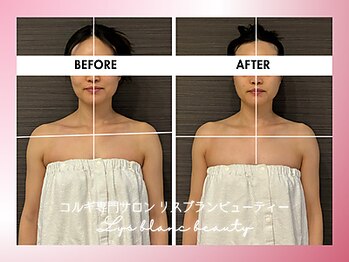 リスブランビューティー(Lys Blanc Beauty)/９０分コルギBefore×After