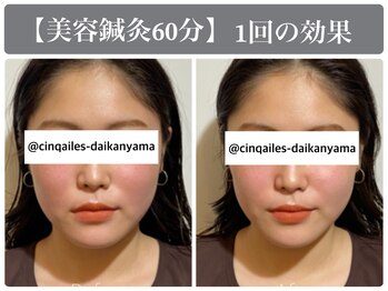 サンクエール 代官山鍼灸院(CINQ AILES)/美容鍼灸　小顔・リフトアップ