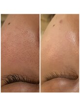 リリーガーデン(Lily Garden)/肌育毛穴ケア