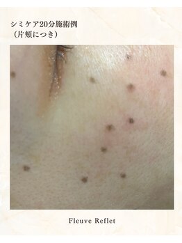 フルーヴ ルフレ(Fleuve Reflet)/シミケア20分　施術例