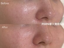 ロエン(Roen)の雰囲気(【PDRN導入】揺らぎ肌/赤み/乾燥)