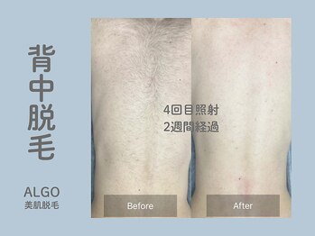 アルゴ 山口宇部店(ALGO)/ショット数4倍!効果抜群!