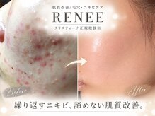 ルネ 松阪(RENEE)