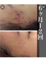 エピ(ep)/陶肌トリートメント６ヶ月１２回
