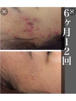 エピ(ep)/陶肌トリートメント６ヶ月１２回