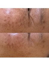 ハドゥ(Ha-DU)/シミとしわ改善ビフォーアフター