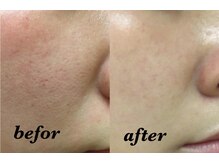 リミューズ マロアマーノ(Re.MUSE MAROaMano)/ララピール2回目LHALALAピール