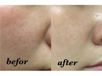 リミューズ マロアマーノ(Re.MUSE MAROaMano)/ララピール2回目LHALALAピール