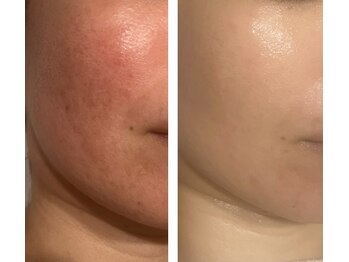 アドビューティ(Add Beauty)/≪プラズマフェイシャル≫