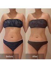 ルナスーリヤ 仙台店/セルドライブプロ☆お腹/背中