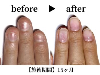 リング ザ ベル(ring the bell)/深爪・育爪専門コース