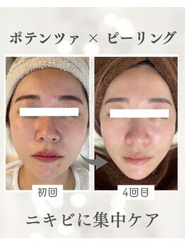 リノ ショウナン(LINO SHONAN)/ポテンツァ×ハーブピーリング