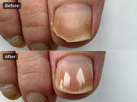 巻き爪矯正ビフォーアフター