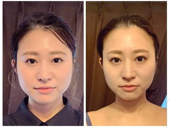 アゴラ/【小顔マシーン】１回目で実感