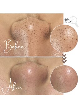 ボータン 恵(Beau Temps)/毛穴ケア/毛穴洗浄　【施術例】