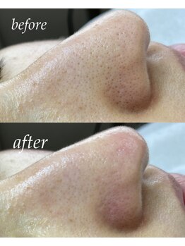 サロン ド ソワン(salon de soin)/毛穴エクストラクション