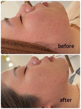 マーキュリー(Mercury)/美容鍼灸×ハーブのお客様