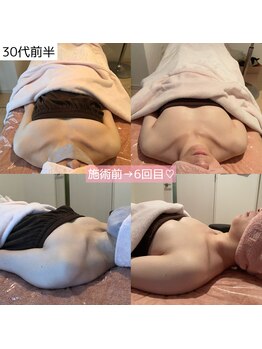 ルト(RUTO)/40代の下垂も細胞から若.返り◎