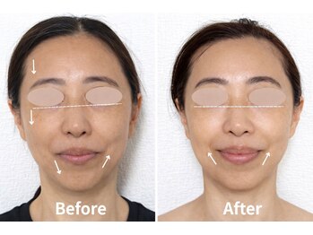 ジェイミープラス 表参道(J‘aimee +)/小顔・レモンボトルの変化