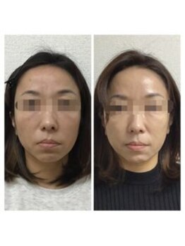 ベルナ(BELUNA)/Before After